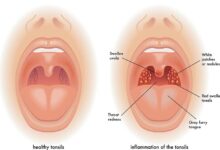 Can Tonsils Grow Back After Being Removed? - Tymoff