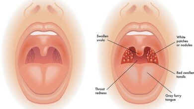 Can Tonsils Grow Back After Being Removed? - Tymoff